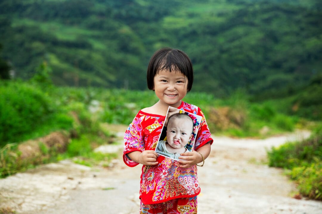 Li Wen after cleft surgery. Photo: Jorgen Hildebrandt