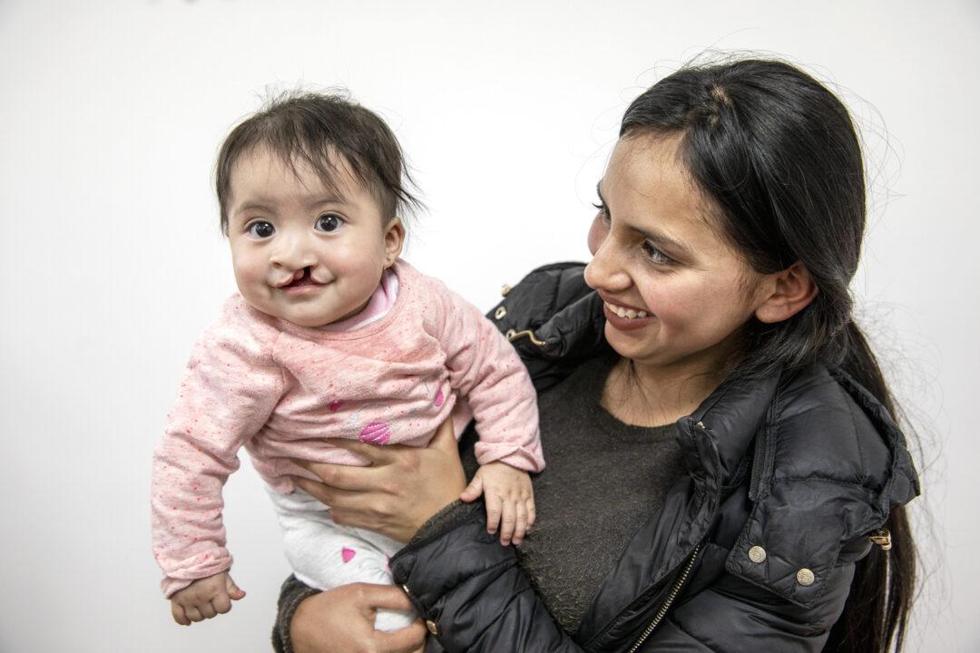 Seven-months-old Genesis smiles before cleft surgery. Photo: Lorenzo Monacelli