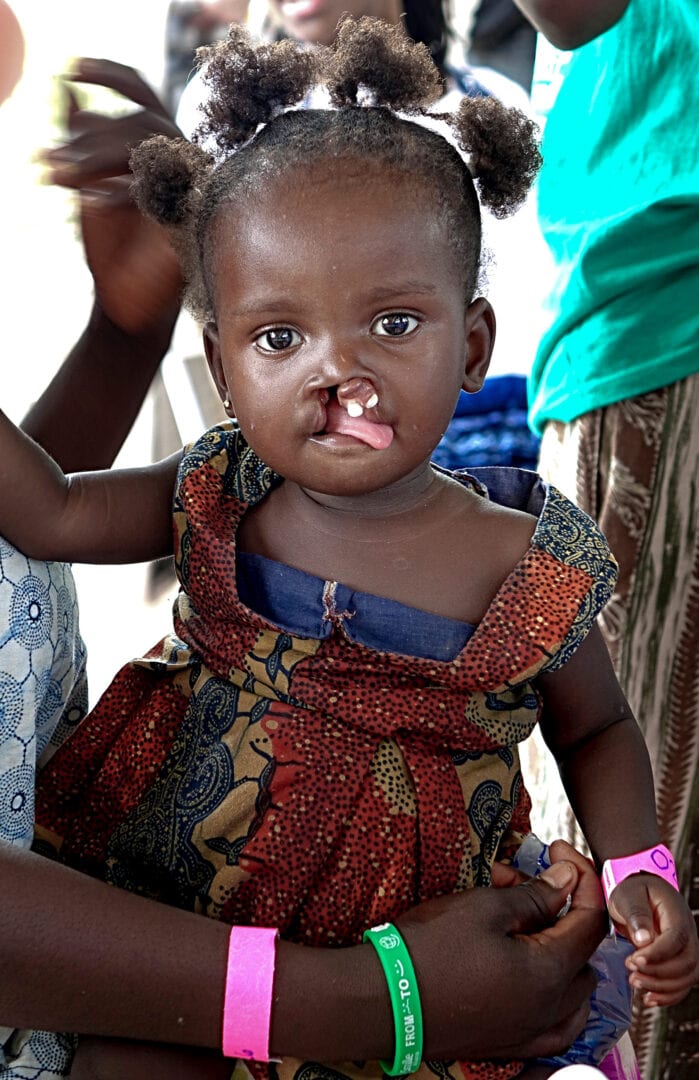 Baby afia before cleft surgery