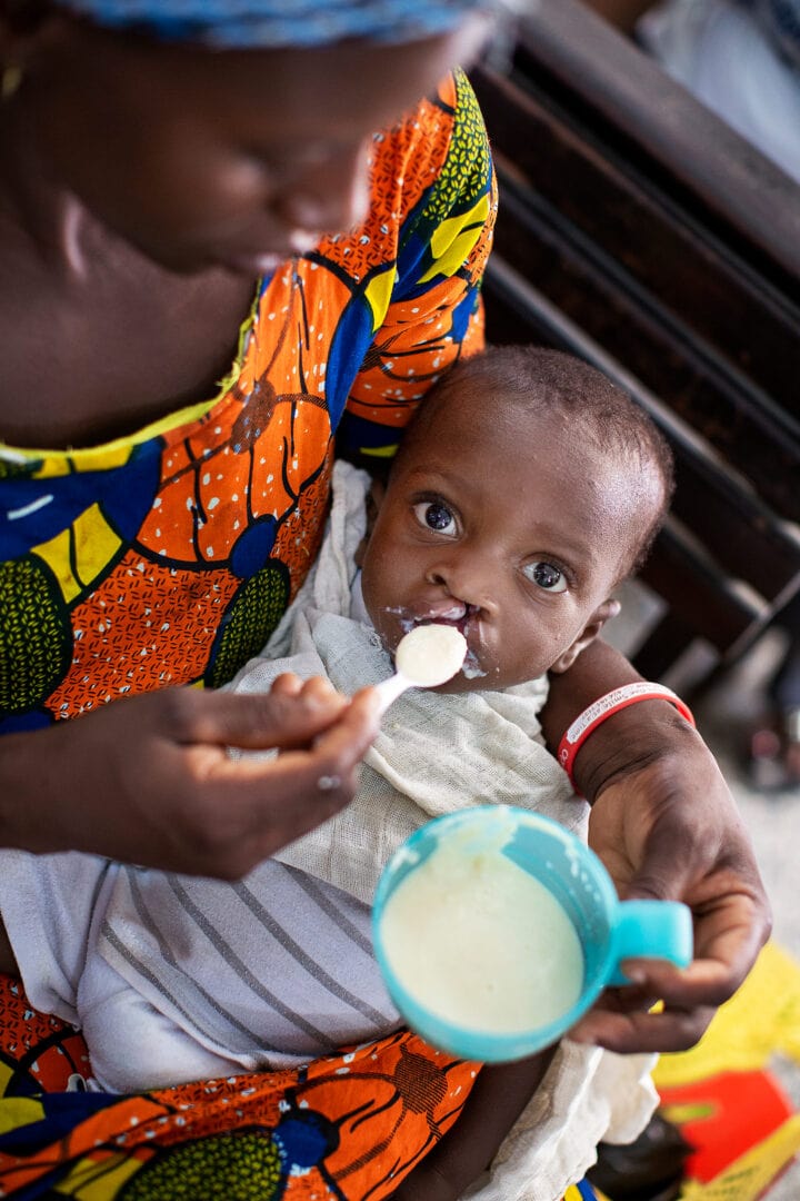 Mum spoon feed baby with cleft