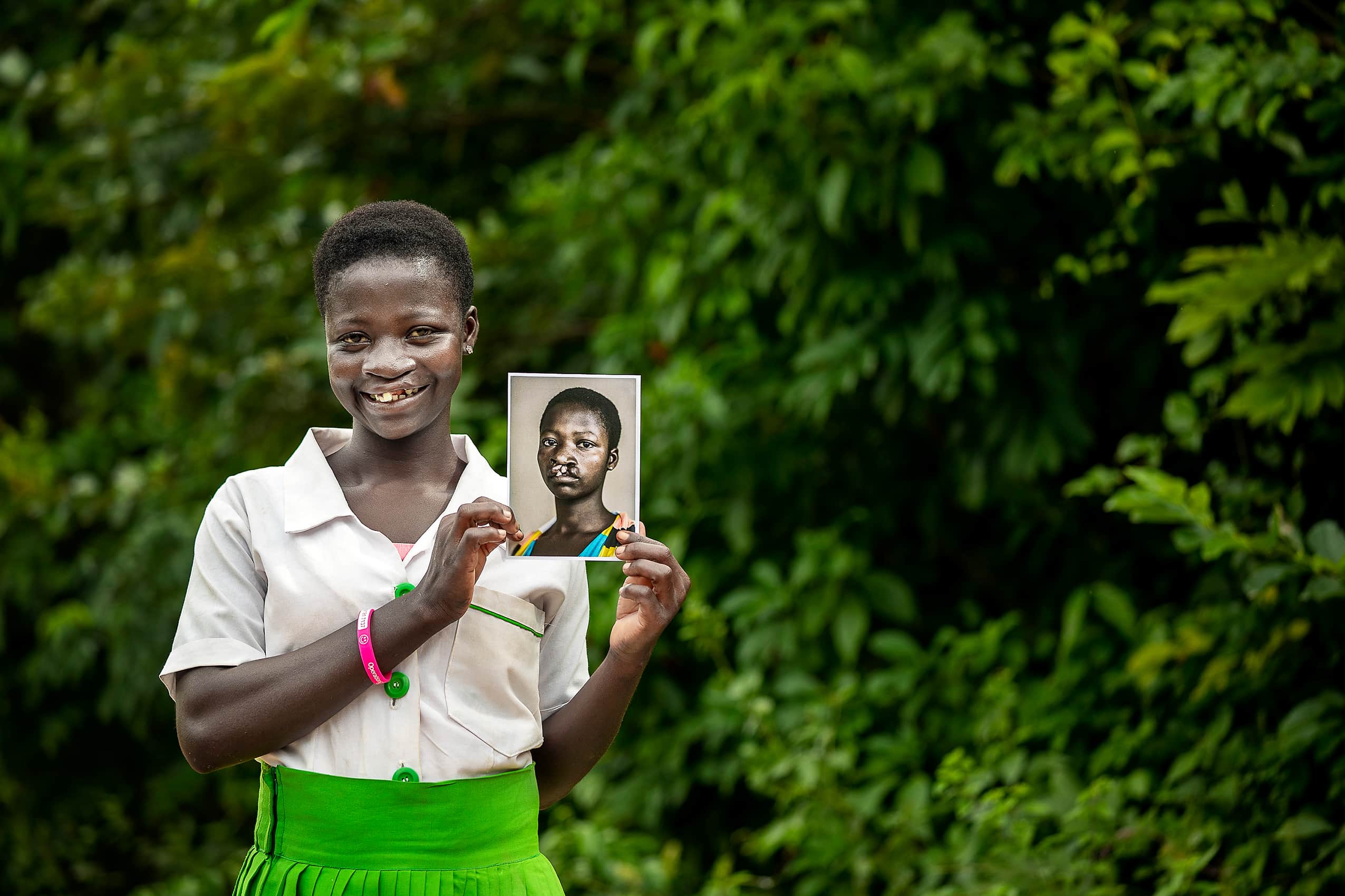 Faustina holds a photo of herself before her cleft surgery