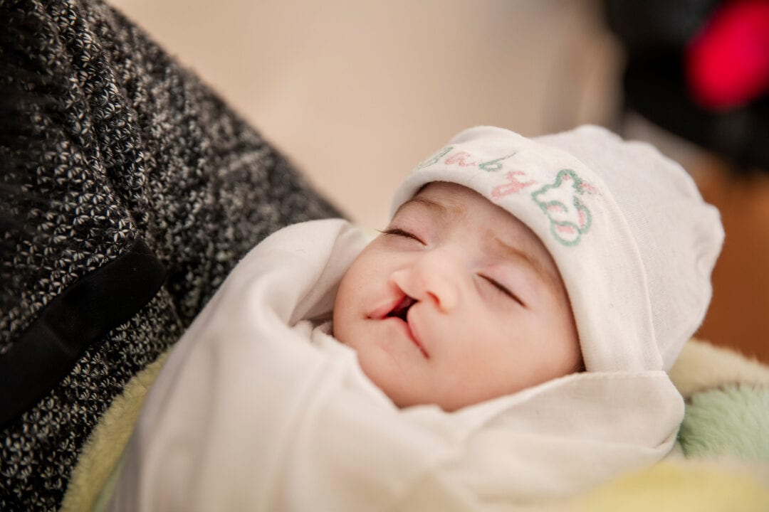 Newborn Janat with a cleft lip and cleft palate