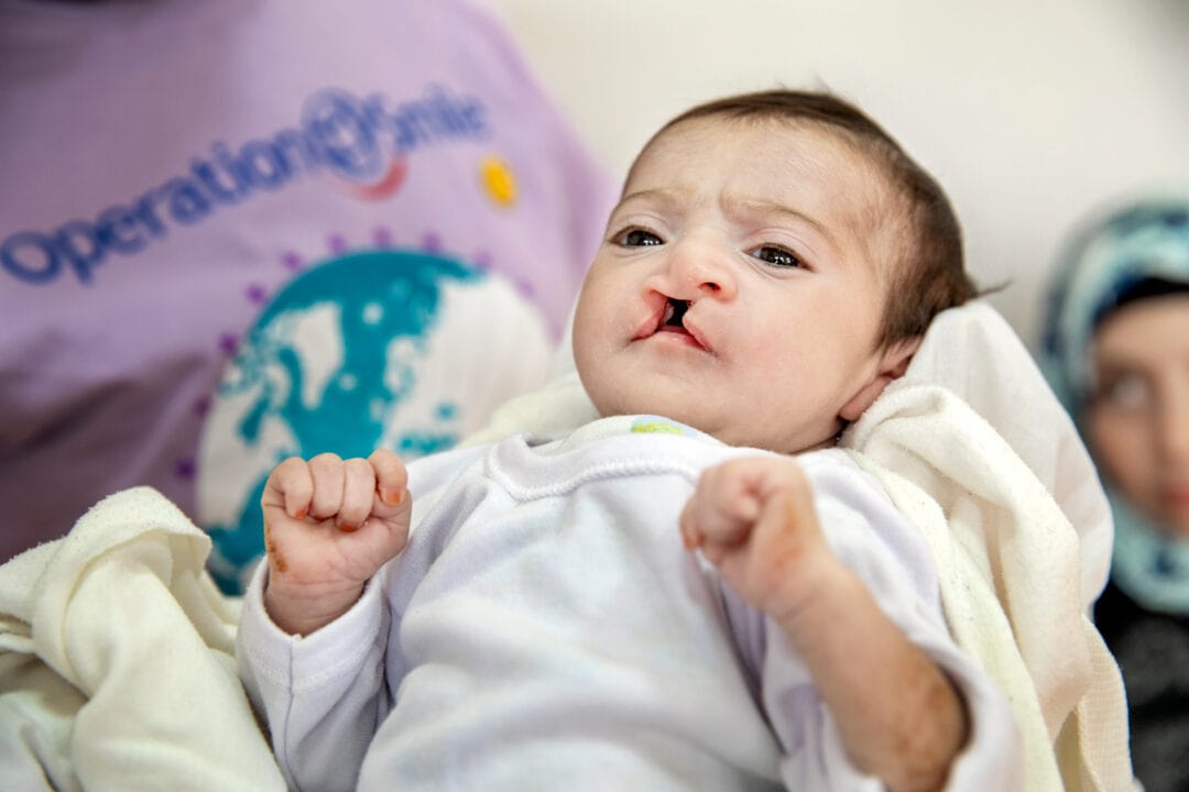 Newborn Janat with cleft lip and cleft palate