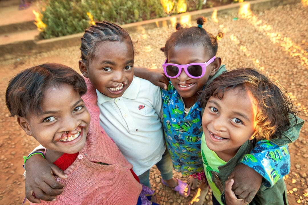 Clara and other children with cleft lip and cleft palate play