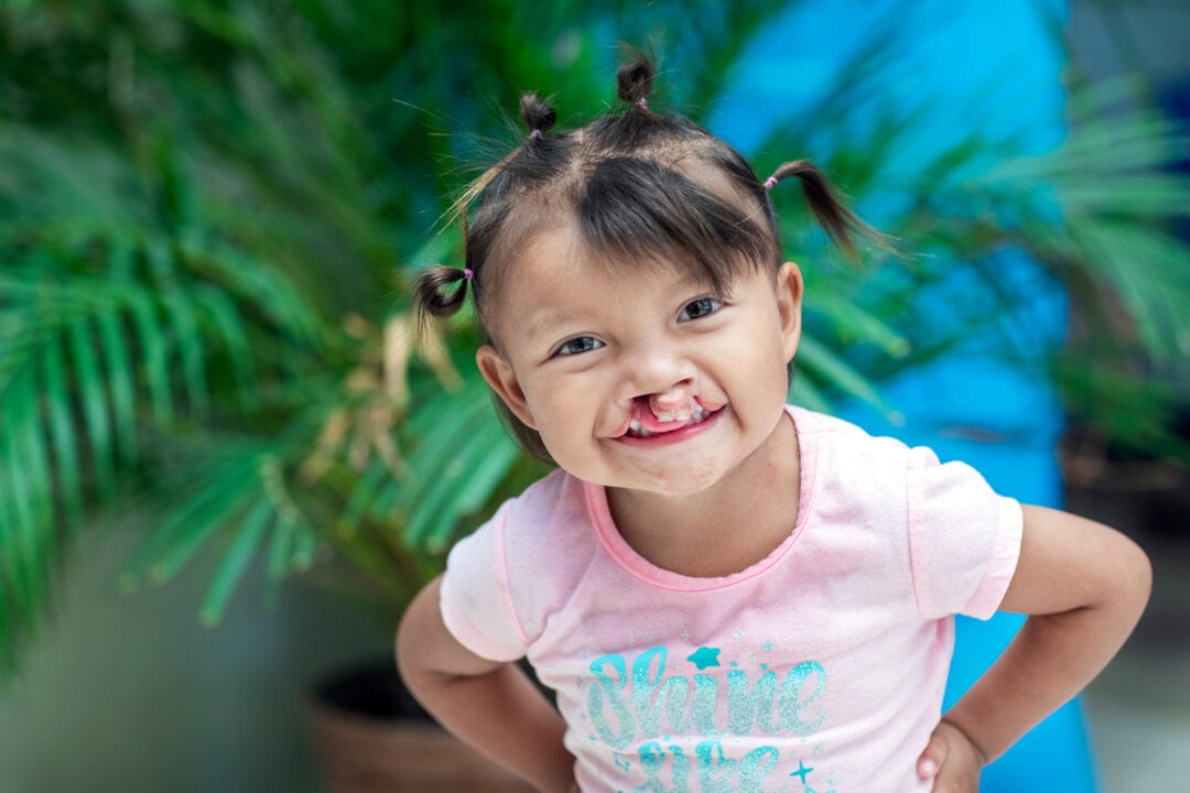 Girl with cleft lip smiling at the camera