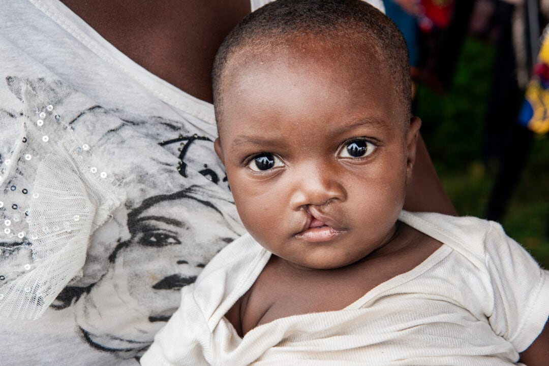 Tumpale before his cleft surgery