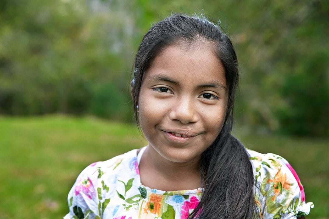 Iris after the surgery to repair her cleft lip. Photo: Jorgen Hildebrandt