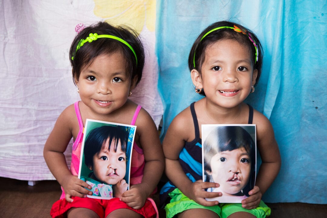 Sisters holding photos of themselves before cleft surgery