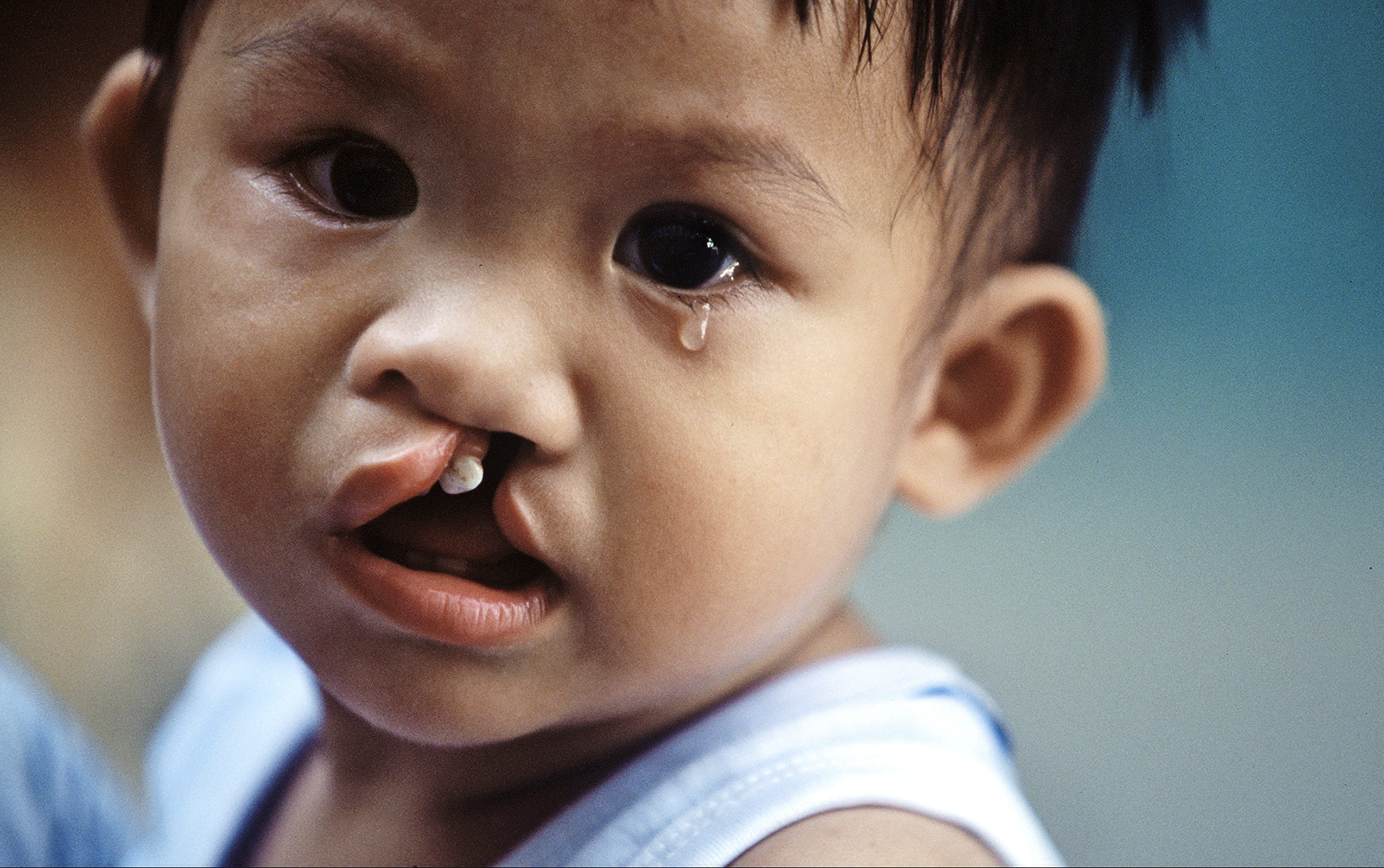 Crying girl with a cleft lip and cleft palate