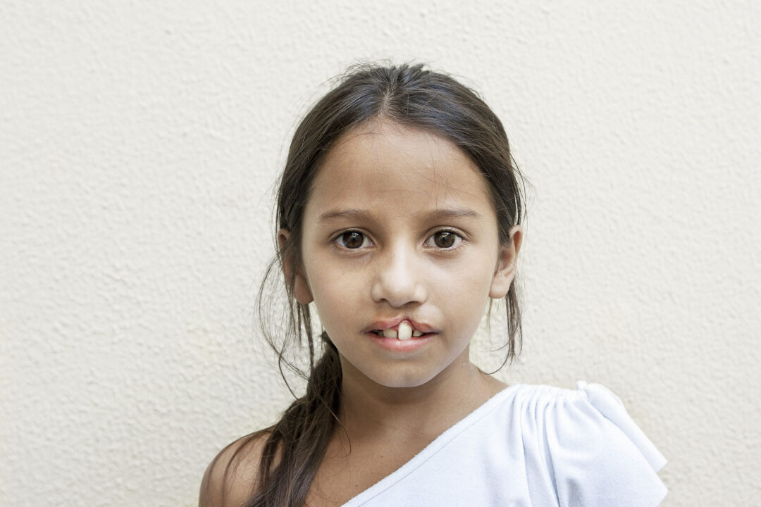 Antonia before her life changing cleft surgery. Photo: Marc Ascher