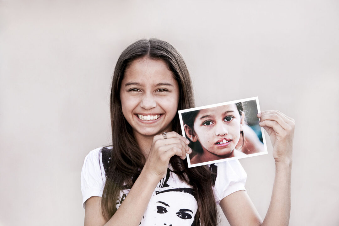 Antonia after her life changing cleft surgery