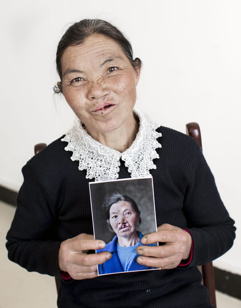 Shang Rong after her life-changing cleft surgery