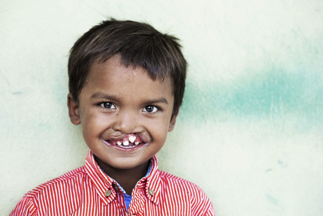 Pedro before his cleft surgery