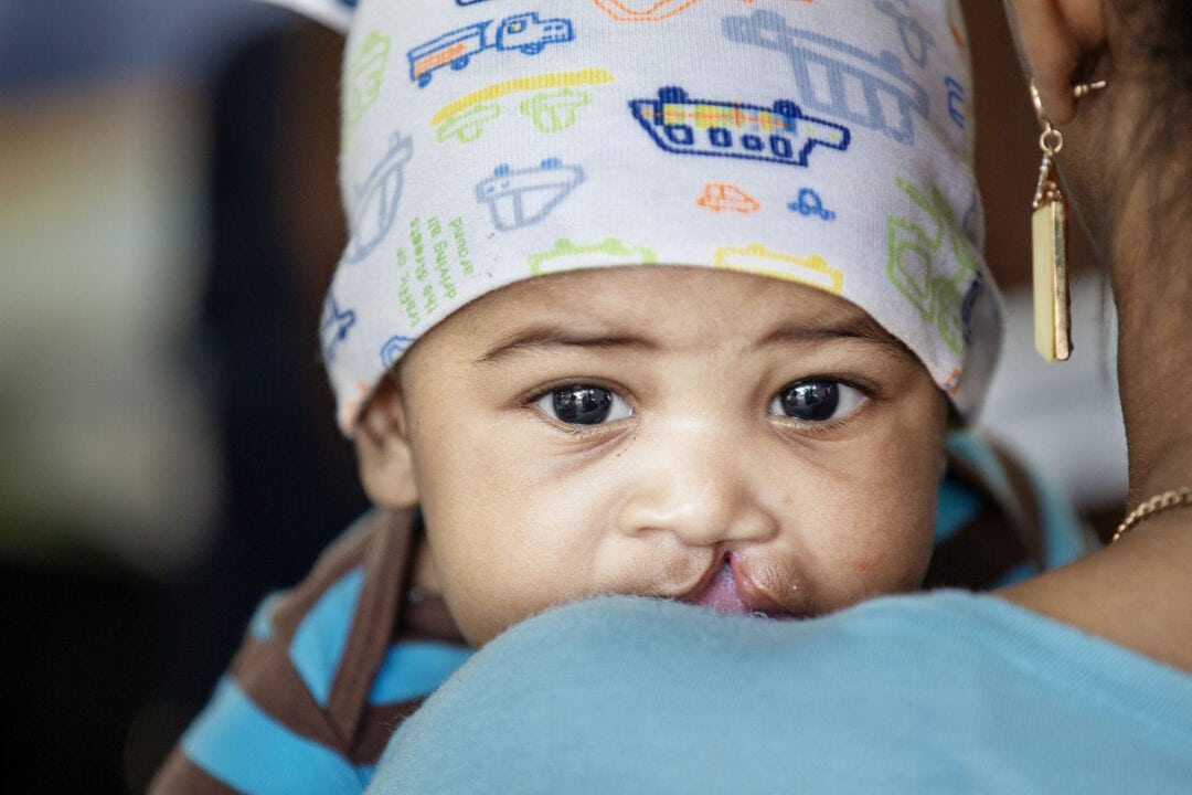 Jose Luis before his cleft surgery