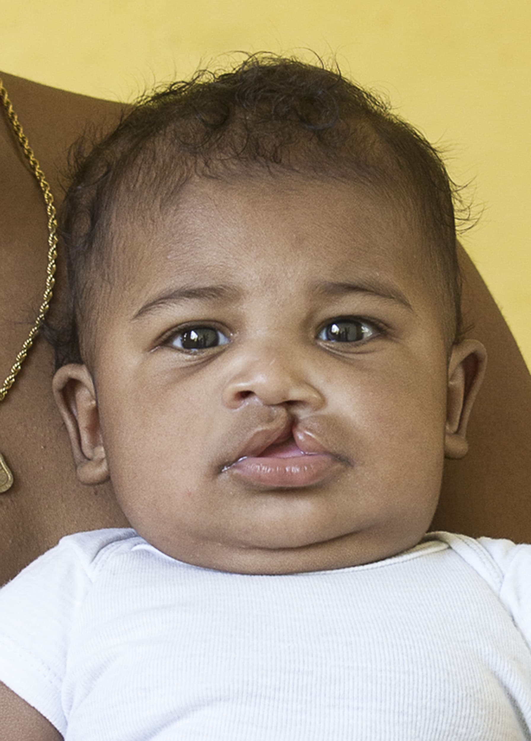 Jose Luis before his cleft surgery