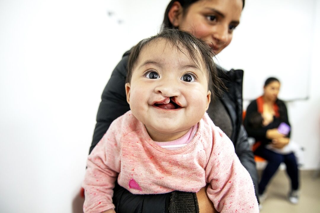 Five-months-old Genesis smiles before cleft surgery. Photo: Lorenzo Monacelli