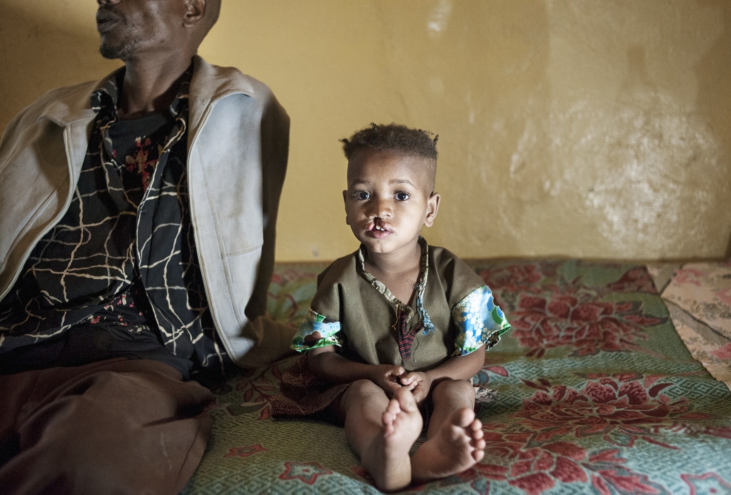 Four-year-old Nazifa, before cleft surgery. Photo: Margherita Mirabella.