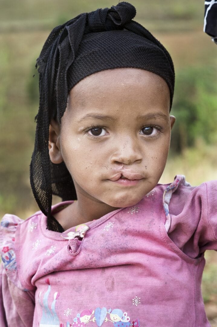 Nazifa's stitches from her first surgery from Operation Smile reopened after falling while playing with friends. Photo: Margherita Mirabella.