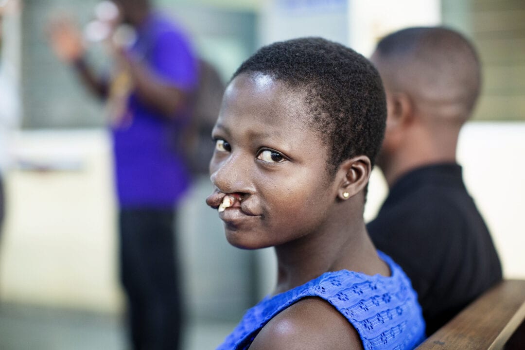 Faustina before her life-changing cleft surgery