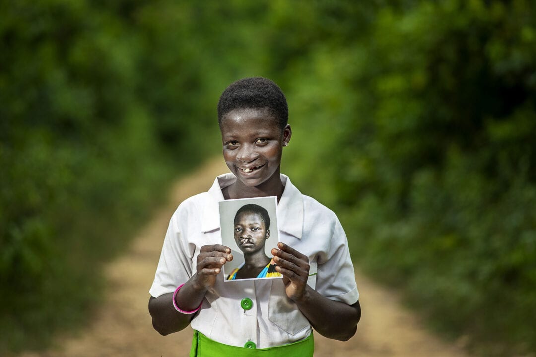 Faustina after her life-changing cleft surgery