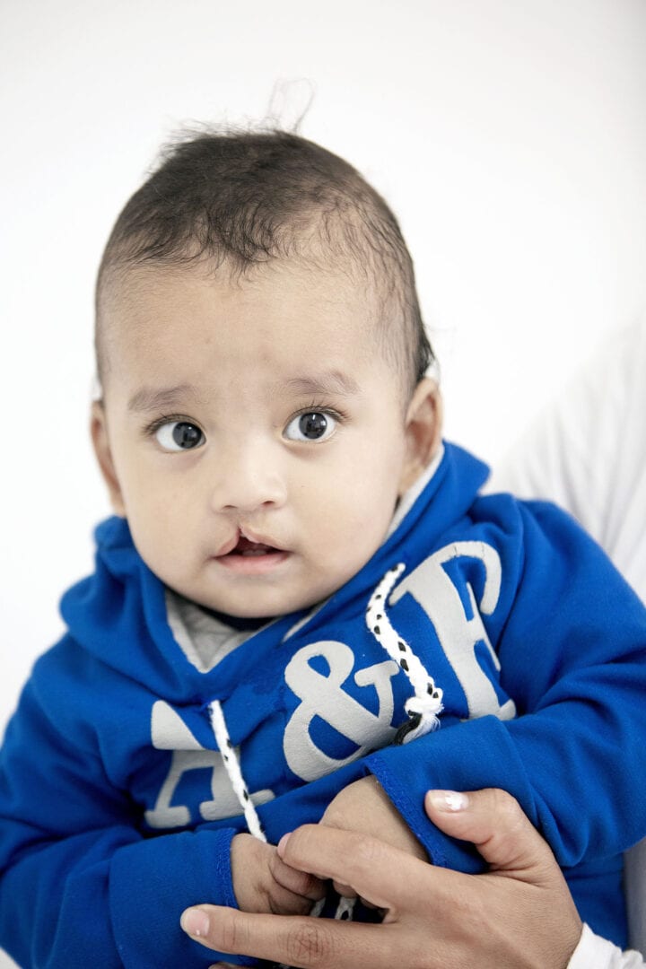 11 month Ethan born with cleft lip