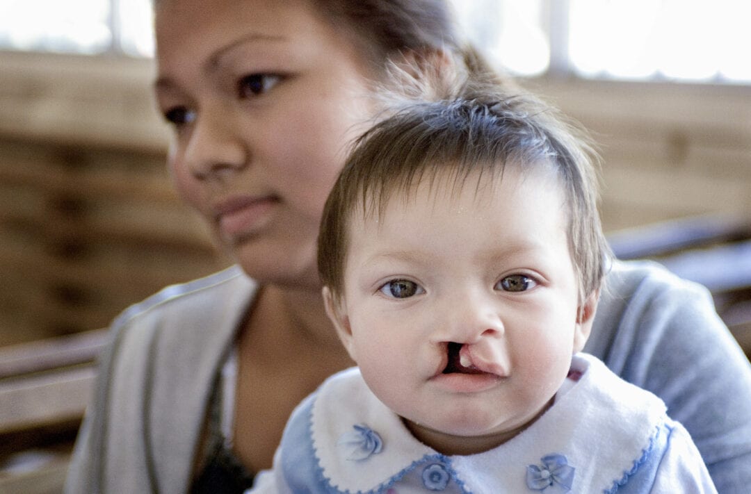 Britany at 10 months old with her mother, Cintia, before surgery at the Operation Smile Honduras care centre. Photo: Angela Weedon