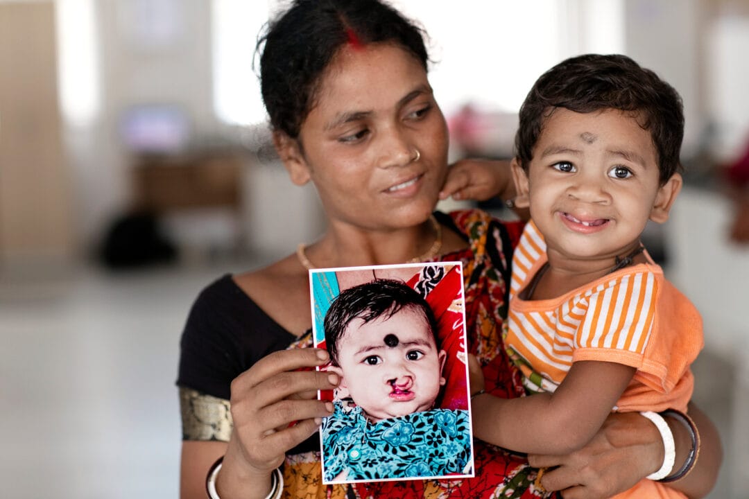 Mum holding son and photo of him before his cleft lip and cleft palate surgery