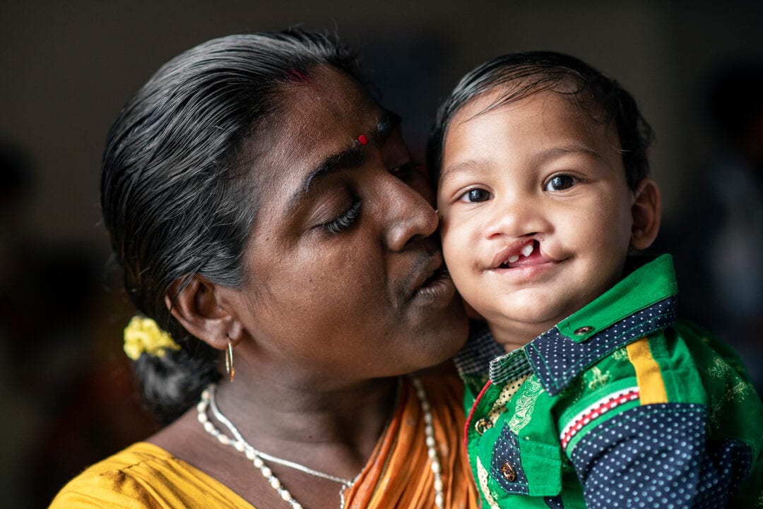 11-months-old Surojito, before cleft Surgery in India. Photo: Rohanna Mertens