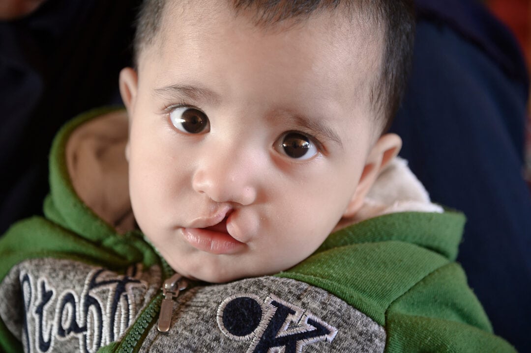 Mahmoud seven-month-old, before cleft surgery, during screening. Photo: Rohanna Mertens