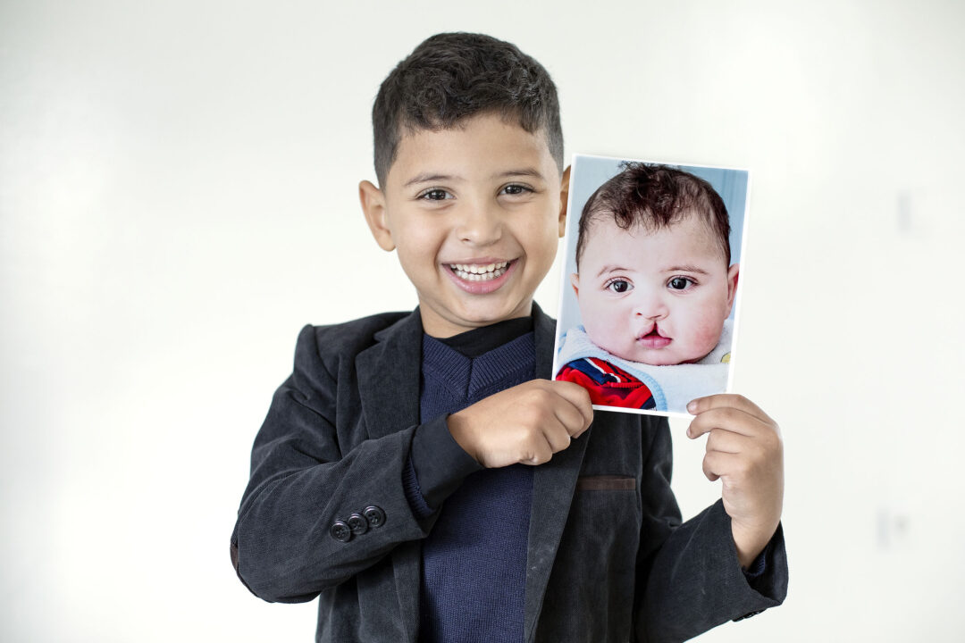 Mohamed after his life changing cleft surgery