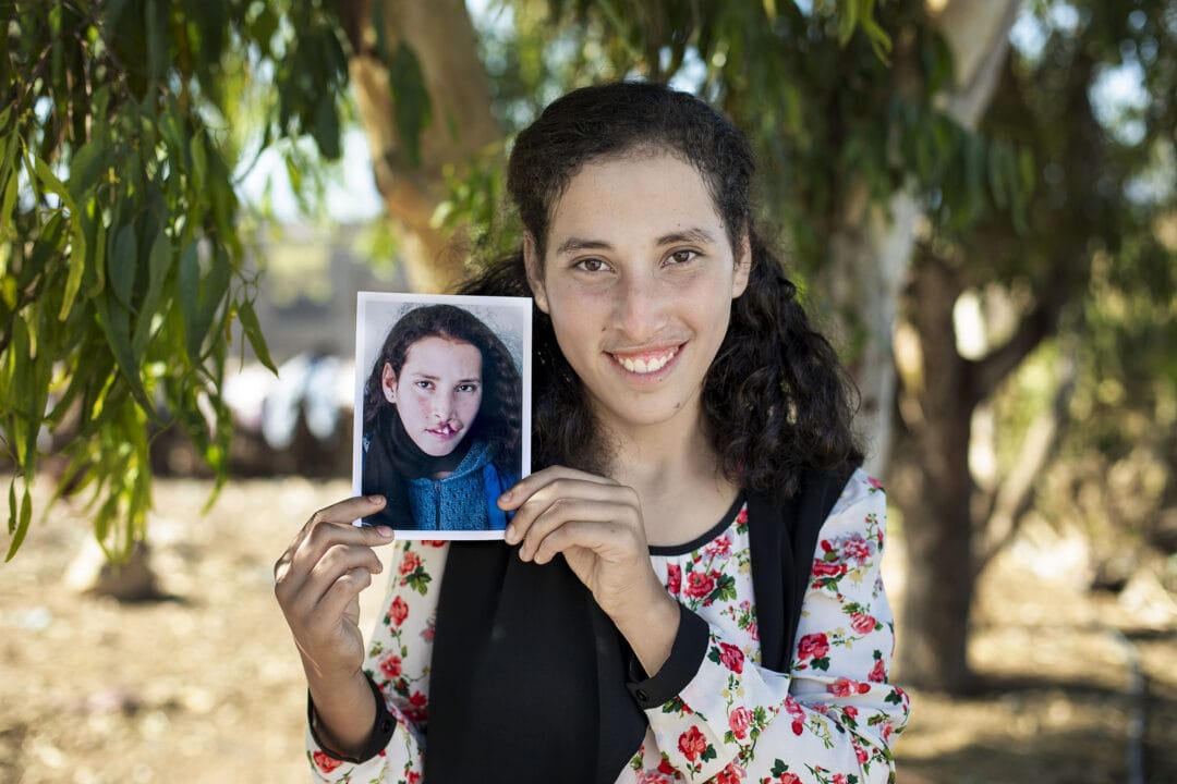 Siham after her life changing surgery. Photo: Lorenzo Monacelli