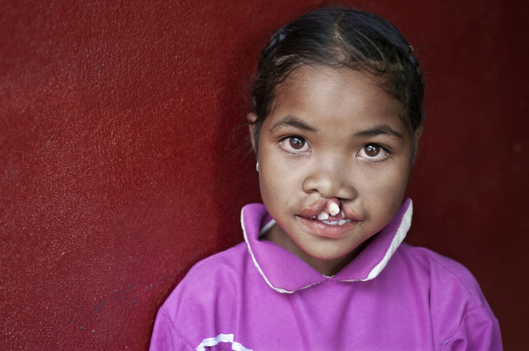 Marie Angeline before her life-changing cleft surgery