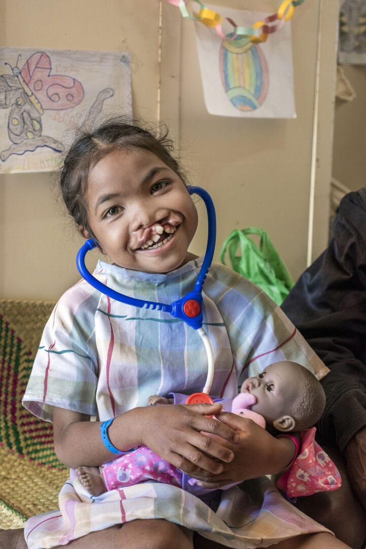 Marie Angeline before her cleft surgery