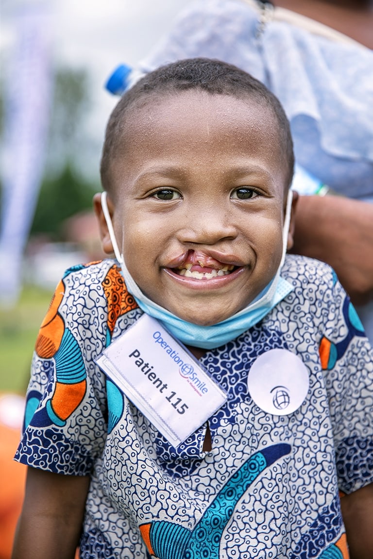 Six-years-old Honoré, before cleft surgery. Photos: Jörgen Hildebrandt