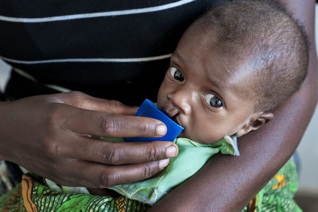 Malnourished baby with a cleft lip receiving treatment in Malawi