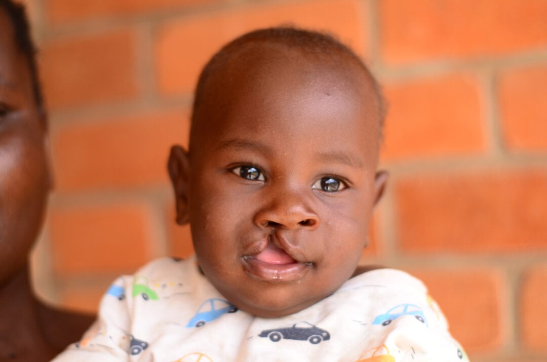 Edwim before cleft surgery. Photo: Operation Smile Malawi
