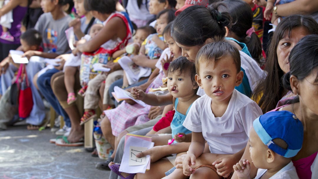 Patients with cleft waiting for surgery