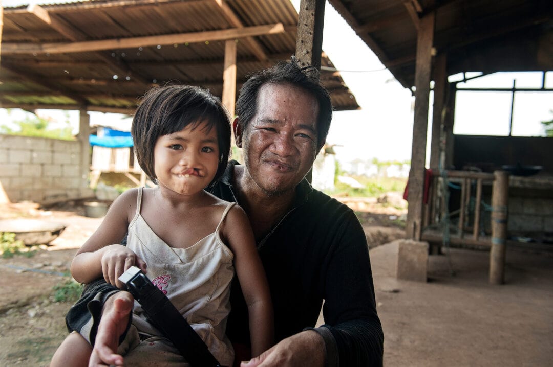 Loraine with dad, before cleft surgery: Jessica Brandi Lifland