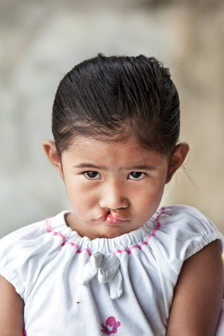 Sad girl with a cleft lip