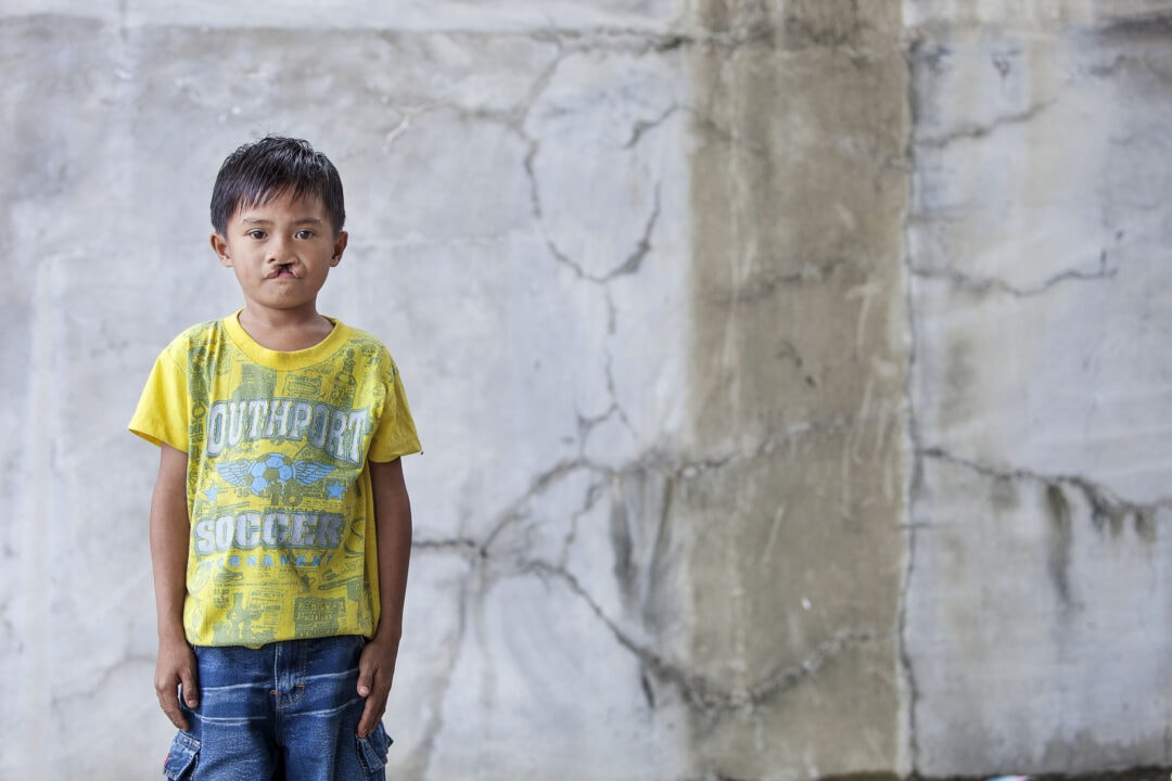 Aljay before his life-changing cleft surgery