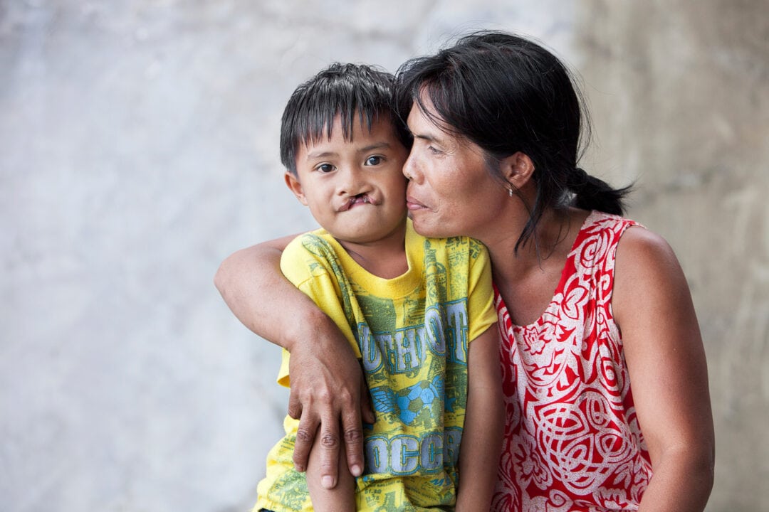 Alijay and his mum before cleft surgery