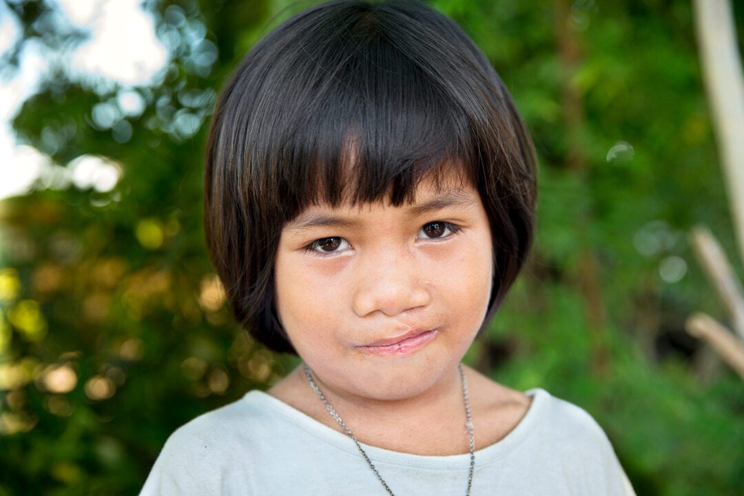 Loraine after cleft surgery. Photo: Jörgen Hildebrandt