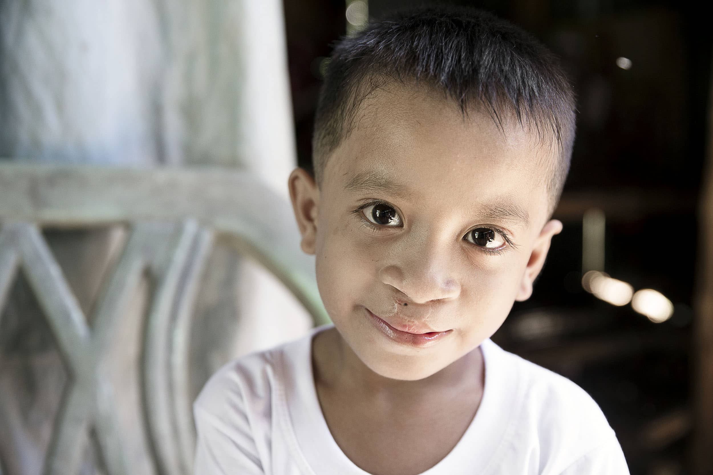 Joseph after his life-changing cleft surgery. Photo: Jörgen Hildebrandt