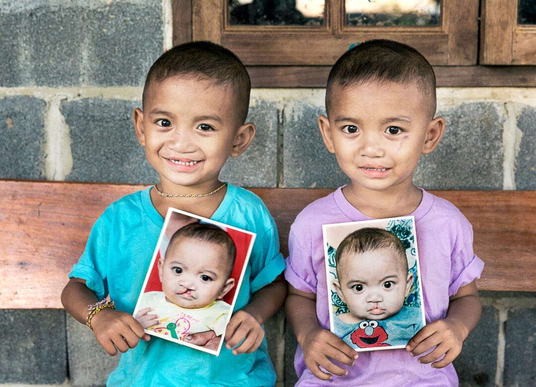 Twin brothers, both born with cleft lip and cleft palate, hold a photo of themselves before surgery