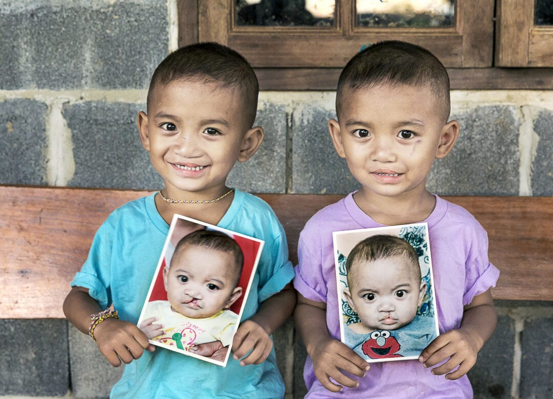 Ou and Lak after their life changing cleft surgery