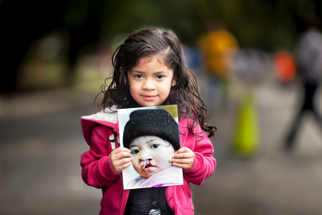 Alexandri three years after cleft surgery. Photo: Carlos Rueda