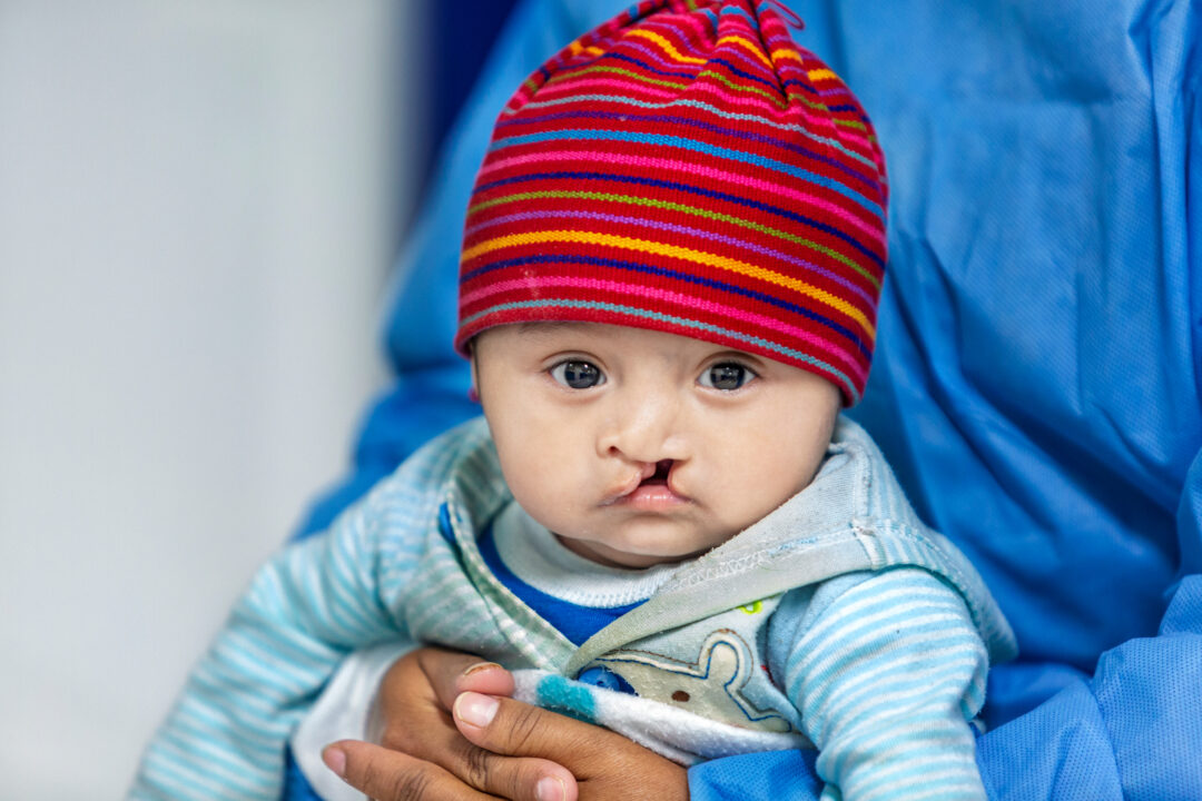 Baby with cleft