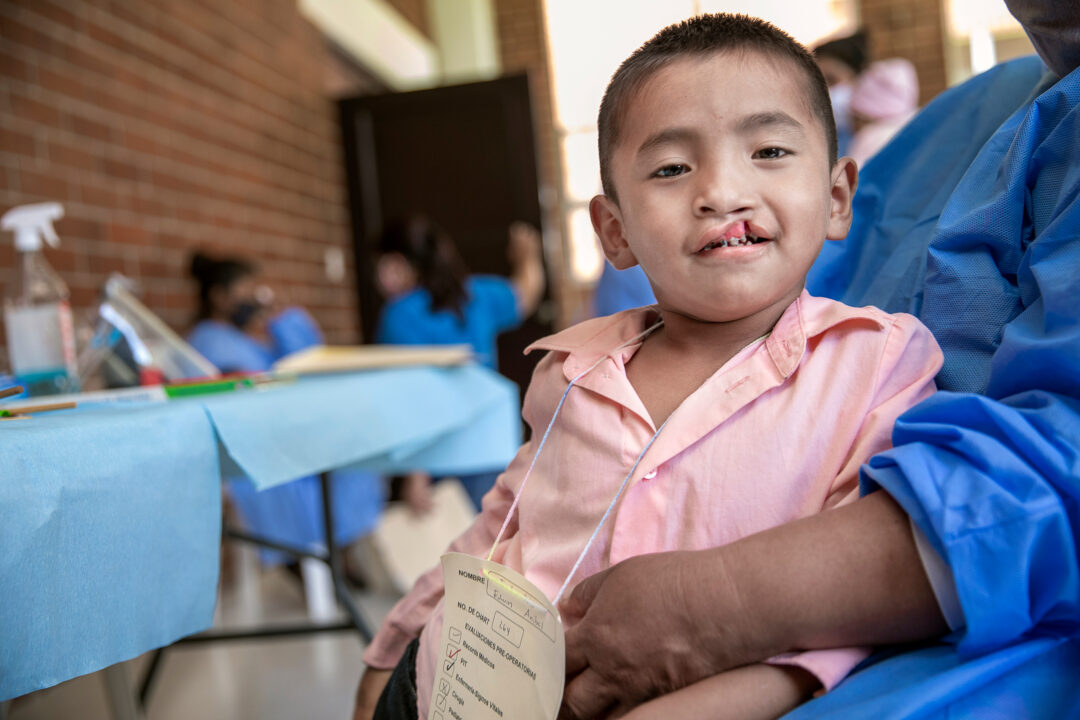 Six-year-old Erwi before cleft surgery, Guatemala 2021. Photo: Jasmin Shah