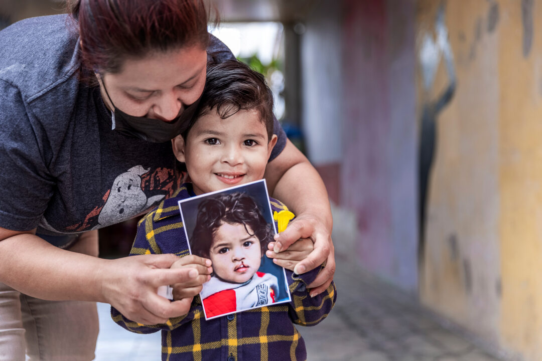 Three-years old boy holding a photo of himself before cleft surgery.