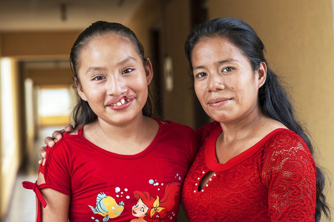 Eleven-year-old Dayana, left, and her mom, Eluvia, attended Operation Smile Guatemala’s May 2022 surgical programme in Guatemala City where she received her long-awaited cleft lip surgery. Photo: Rohanna Mertens.